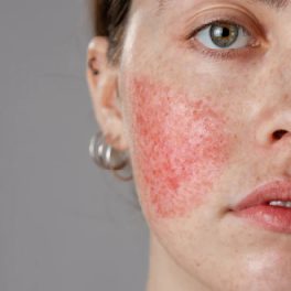 Rozaceás Bőr